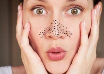 Защо се появяват черните точки и как да се борим с тях?